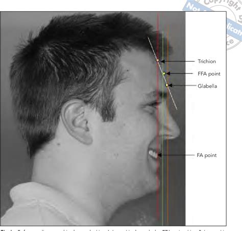 anteroposterior|anteroposterior relationship.